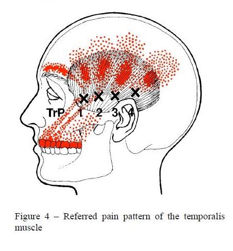 The antiepileptic drugs carbamazepine and oxcarbazepine are the first-line pharmacological treatment for <strong>trigeminal neuralgia</strong>. . Trigeminal neuralgia referred tooth pain chart